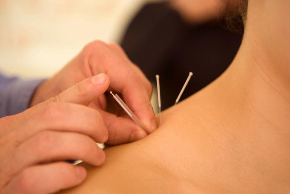 acupuncture treatment in Newmarket